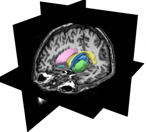 Structures anatomiques du cerveau et une tumeur (Equipe IMAGES)